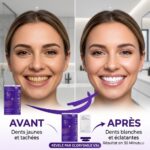 BLANCHISSEMENT DENTAIRE – Image 3